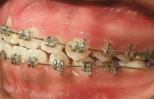 Fig. 14 Lateral izquierda