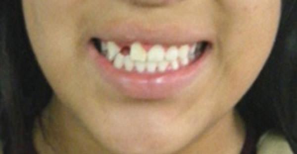 Fig.17 Final sonrisa