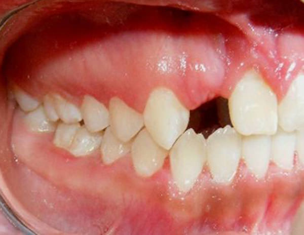 Fig. 19 Lateral derecha sin el lateral