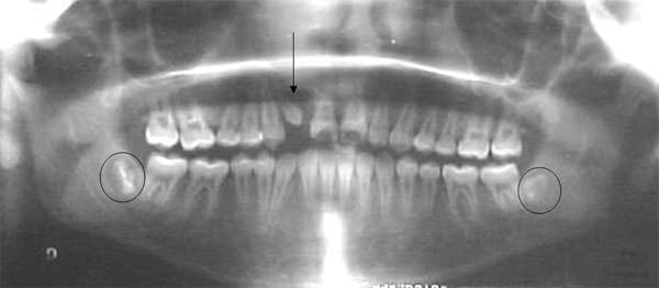 Fig. 22 Rx panoramica final