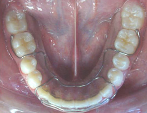 Figura 23 Retenedores