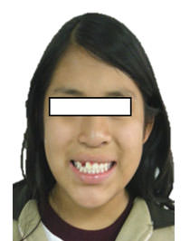 Fig.24 Comparativas de sonrisa inicio progreso final