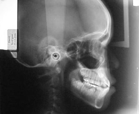Fig. 3 Radiografía inicial lateral de cráneo