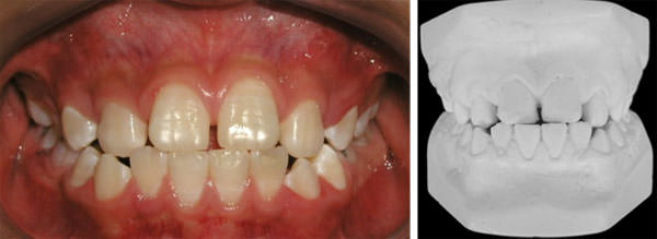 Fig. 5 Inicio intraoral de frente