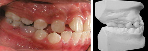 Fig. 6 Inicio intraoral derecha