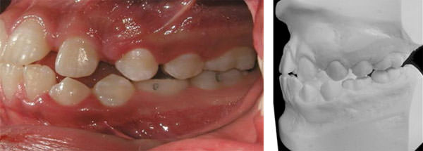 Fig. 7 Inicio intraoral izquierda