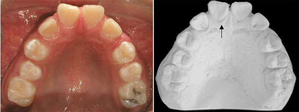 Fig. 8 Inicio intraoral de frente