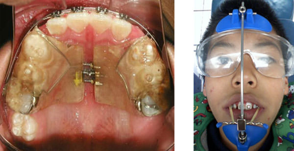 Fig. 10 Hass con pista tipo Pititi