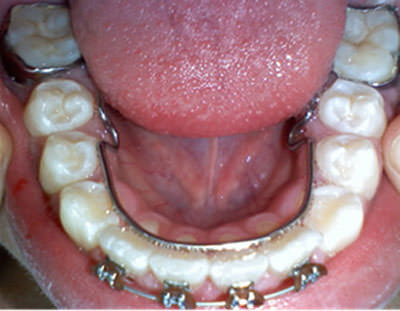 Fig 11 Arco lingual 