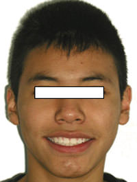 Fig. 17 Final de sonrisa