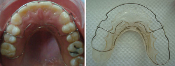 Fig. 21 Retenedor circunferencial superior