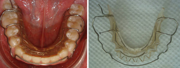 Fig. 22 Retenedor circunferencia inferior con apoyo en segundo molar inferior 