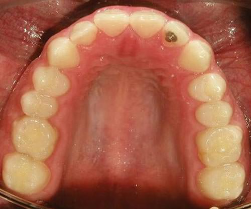 Fig. 7 Fotografía oclusal superior