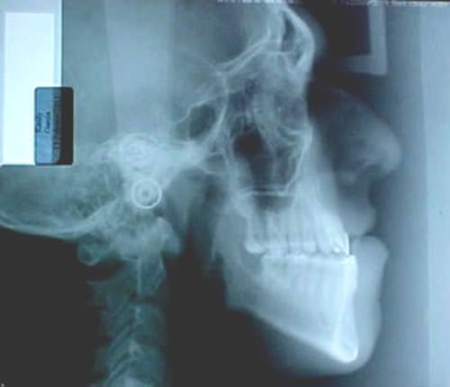 Fig. 9 Radiografía lateral de cráneo