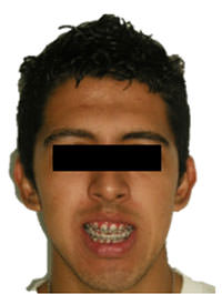 Fig. 12 Fotografía de sonrisa