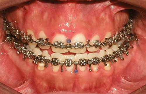 Fig.14 Fotografía intraoral de frente