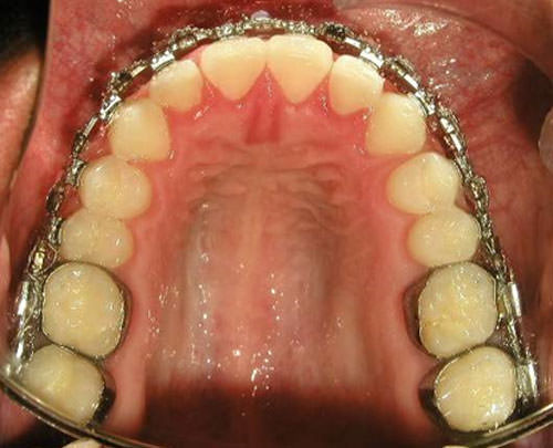 Fig. 17 Fotografía oclusal superior