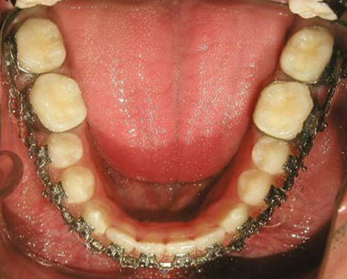 Fig. 18 Fotografía oclusal inferior