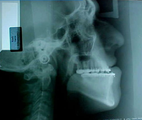 Fig. 19 Radiografía lateral de cráneo