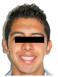Fig. 22 Fotografía de sonrisa