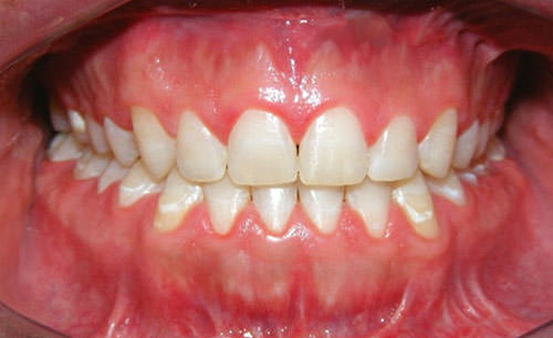 Fig. 24 Fotografía intraoral de frente