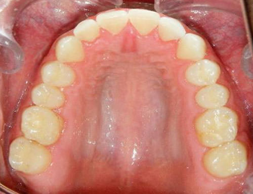 Fig. 27 Fotografía oclusal superior