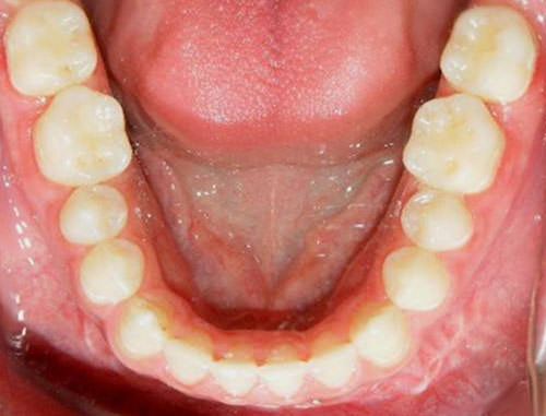 Fig. 28 Fotografía oclusal inferior