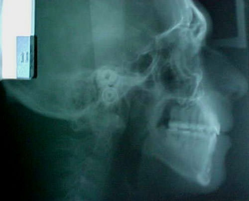 Fig. 29 Radiografía lateral de cráneo