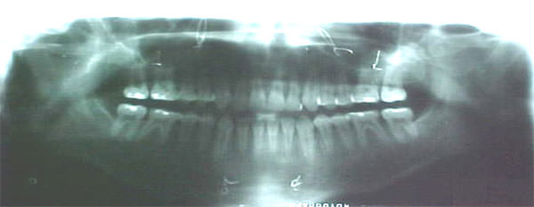 Fig. 30 Radiografía panorámica