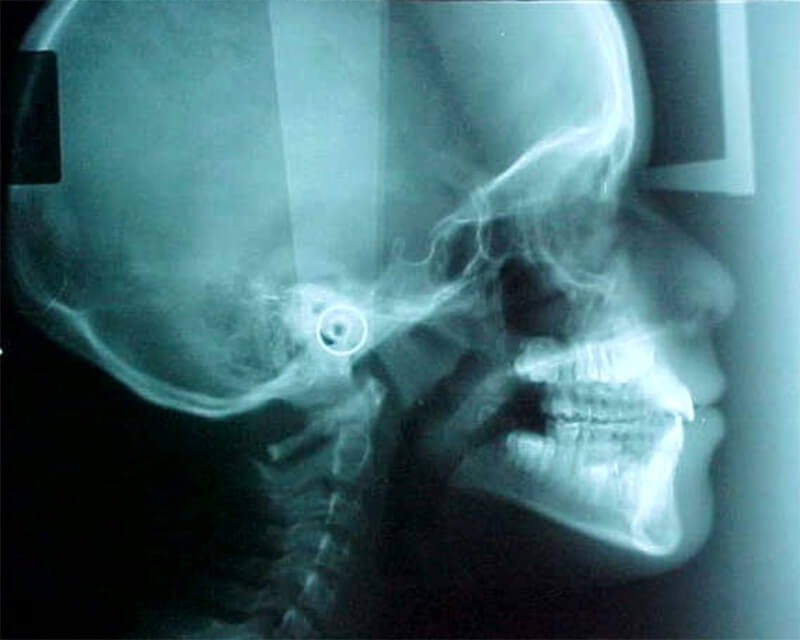 Imagen 1 Radiografía lateral