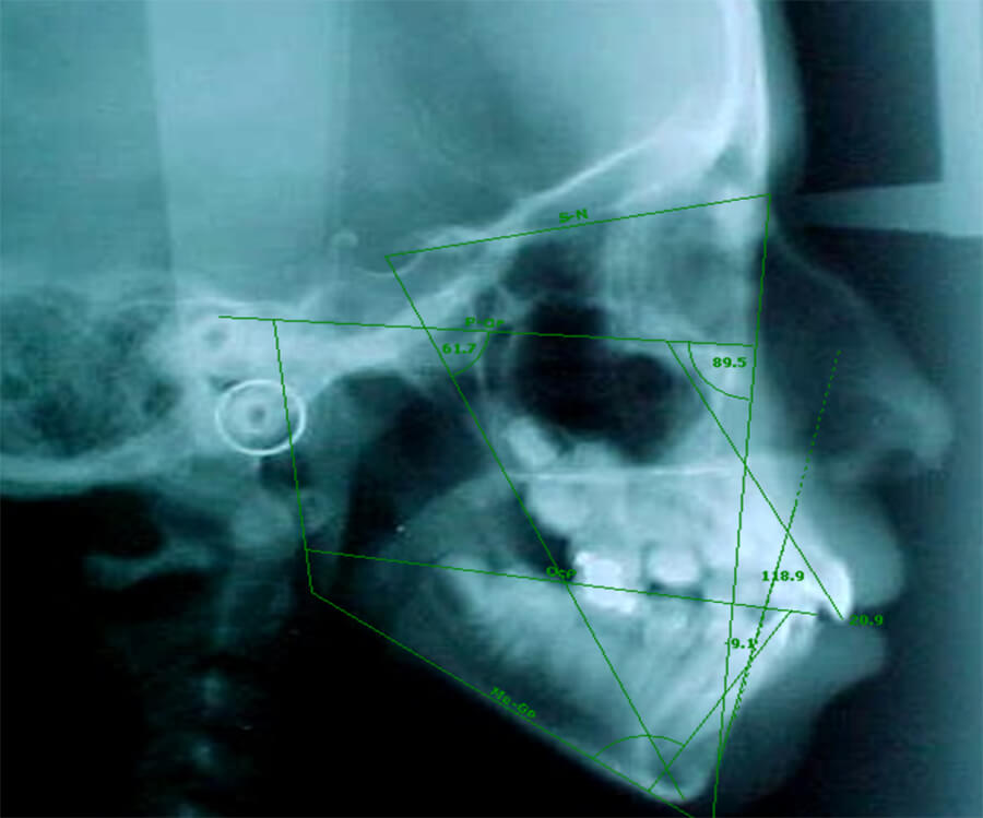 Imagen 2 Trazados cefalométricos según el análisis de Steiner