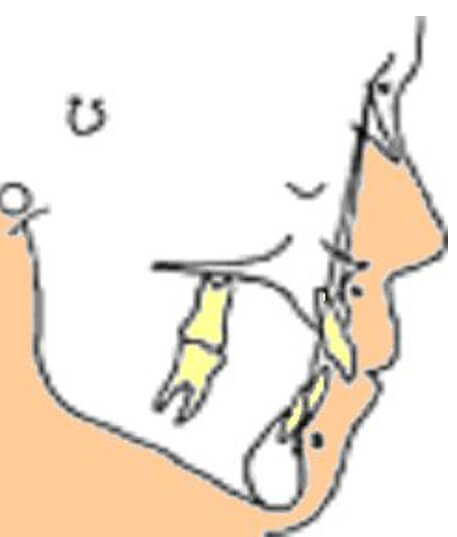Imagen 4 Se mide el ángulo Silla-Nasion-Punto A, ángulo Silla-Nasion-Punto B