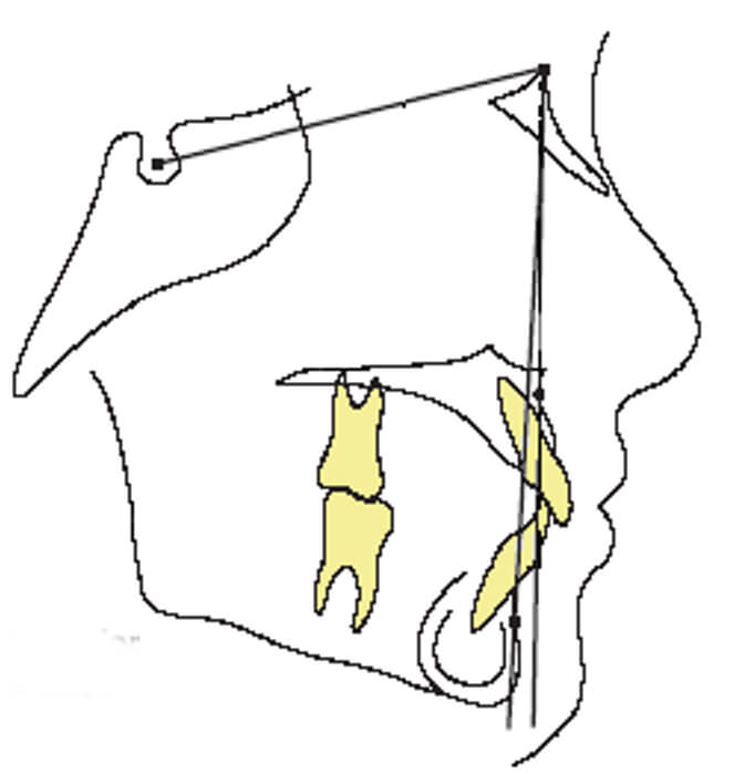 Imagen 10 Higer oclusal plano Angle (1)