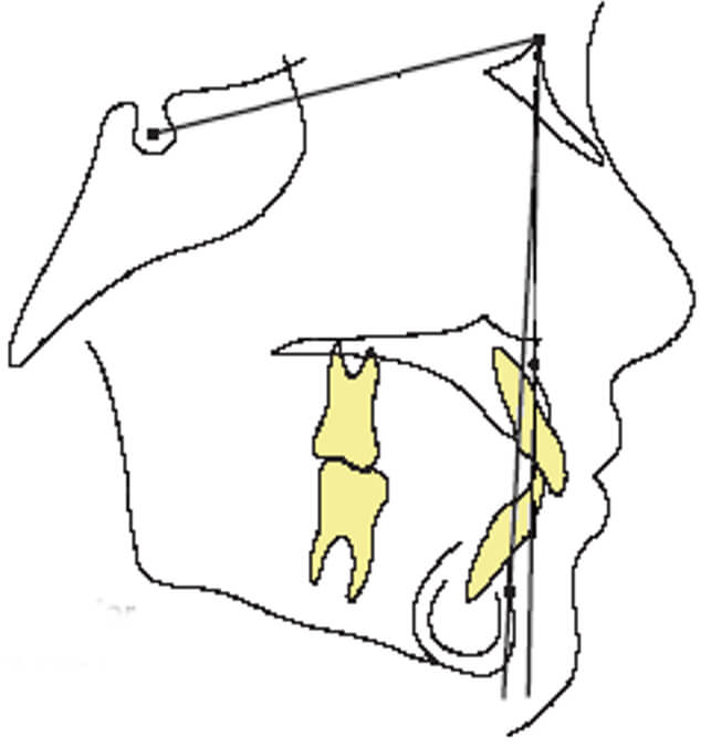Imagen 11 Normal anterior craneal base (1)