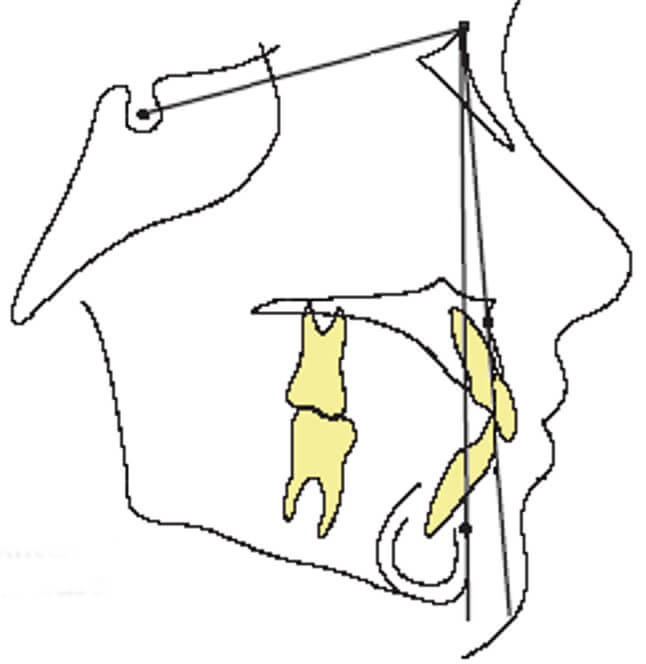 Imagen 12 Short anterior craneal base (1)