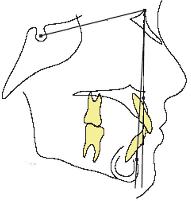Imagen 13 Short anterior craneal base (1)