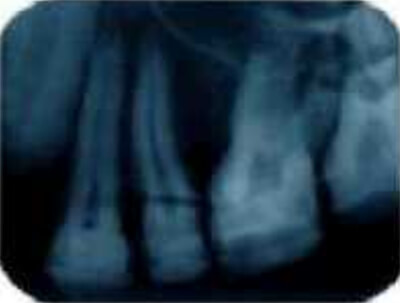 Figura 1 Radiografía periapical