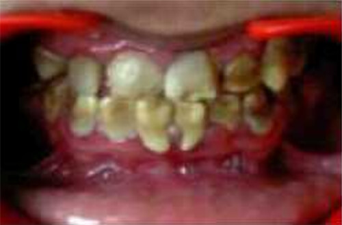 Figura 2 Hipoplasia Dental