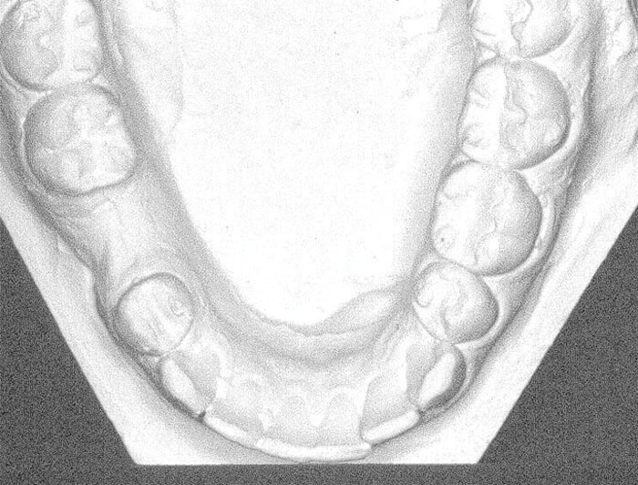 Figura 3 Ausencia del primer molar permanente