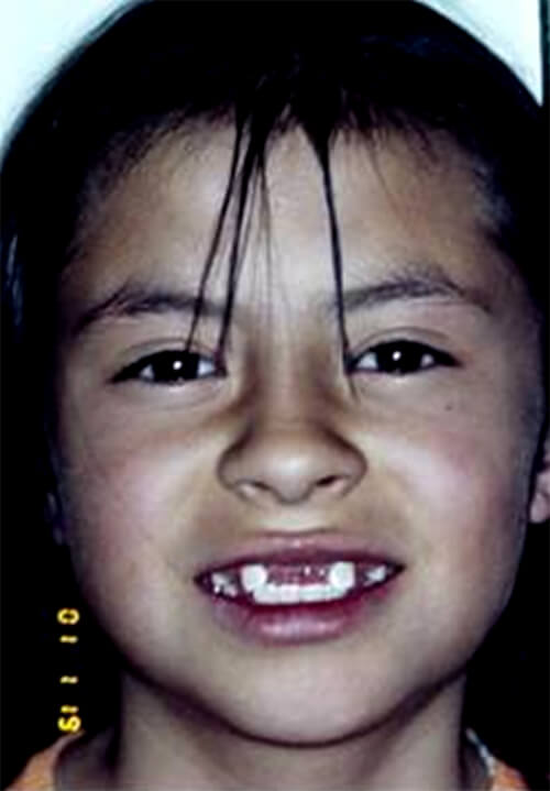 Fig 3 Fotografía inicial sonrisa