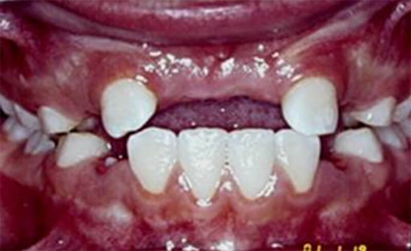 Fig. 4 Fotografía inicial intraoral de frente