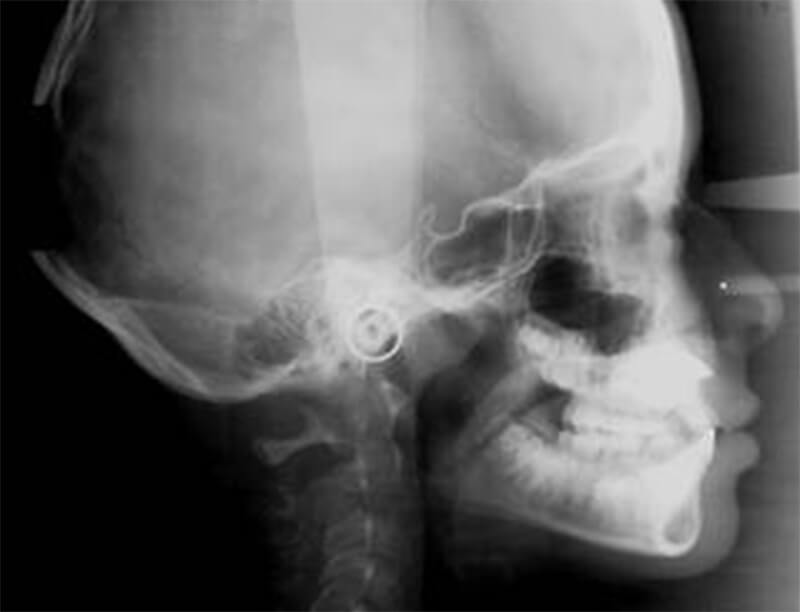 Fig. 5 Cefalometría tomada al inicio del tratamiento