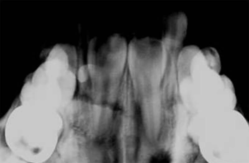 Fig 7 Radiografìa oclusal inicial