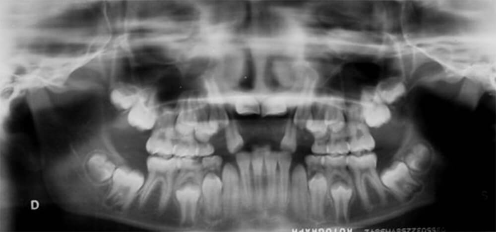 Fig 8 En la radiografía panorámica de inicio observamos los incisivos centrales retenidos.