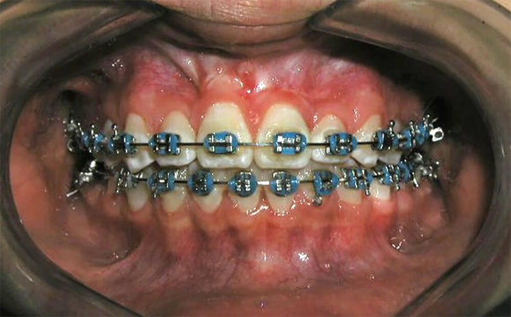 Fig. 15 Progreso II fotografia intraoral de frente