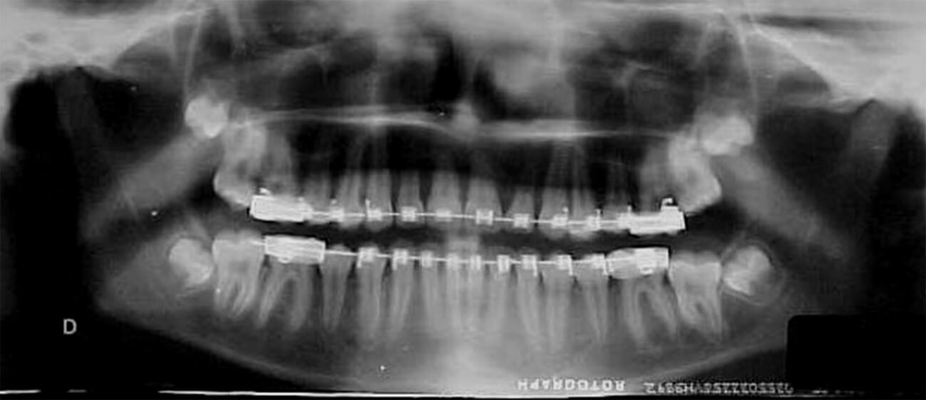 Fig 16 Cefalometria de progreso II