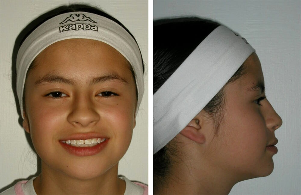 Fig 13 Progreso II de frente / Fig 14 Progreso II de perfil