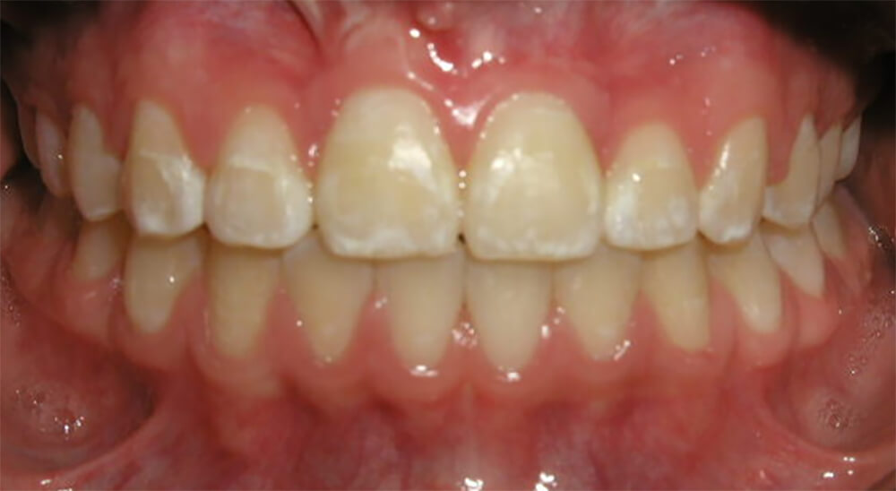 Fig. 19 Fotografía del paciente intraoral al final del tratamiento donde observamos la alineación.