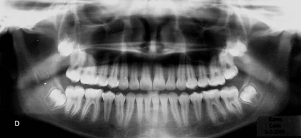 Fig. 21 Panorámica final que nos muestra el paralelismo obtenido de las raíces.