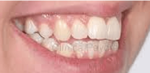 IMAGEN 2, 3: Ejemplos de mordida abierta falsa de tipo dental que abarca generalmente desde canino y su pronóstico llega a ser bueno y en la segunda imagen, mordida abierta verdadera o esquelética abarca hasta nivel de premolares esto indica que su pronóstico es reservado ya que muchas veces llega a ser un tratamiento quirúrgico. (https://ortoperio.net/ortodoncia-lingual-tratamiento-una-maloclusion-compleja-clase-iii-mordida-abierta-paciente-adulto/)